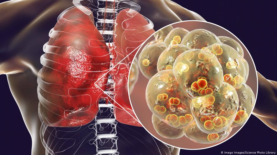 الالتهاب الرئوي “كوفيد 19”.. قاتل مخادع يحير الأطباء
